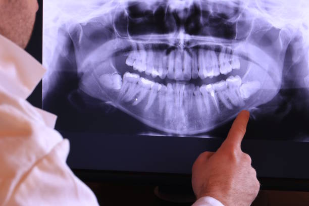 Best Emergency Tooth Extraction in Sandusky, MI
