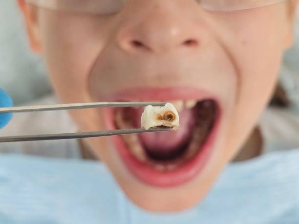 Best Emergency Wisdom Teeth Removal in Sandusky, MI